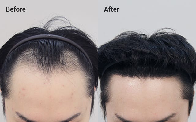 FAQ - After FUE hair transplants | Forhair Korea