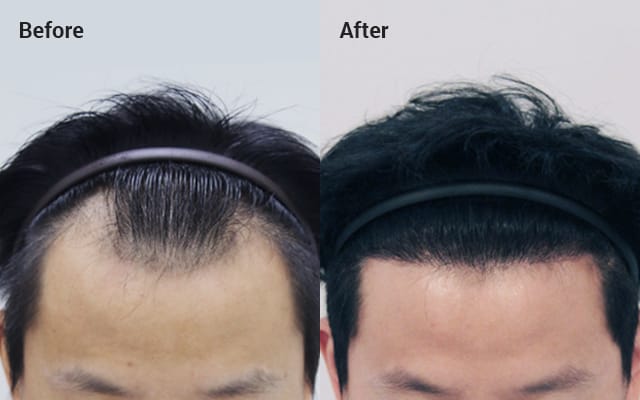 FAQ - After FUE hair transplants | Forhair Korea
