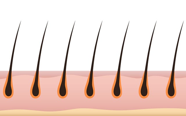 For Hair’s high density slit implantation image