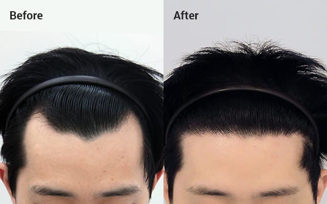 Non-incisional partial shaving, 10 months later image
