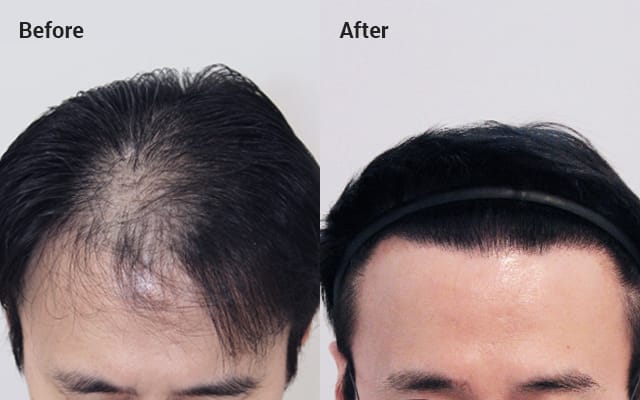 Non-incisional without shaving, 1500 hair follicles, 10 months later image