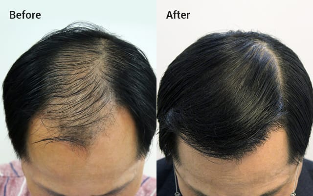 Non-incisional without shaving, 2000 hair follicles, 7 months later image