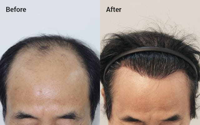 Non-incisional partial shaving 2000 hair follicles, 10 months later image