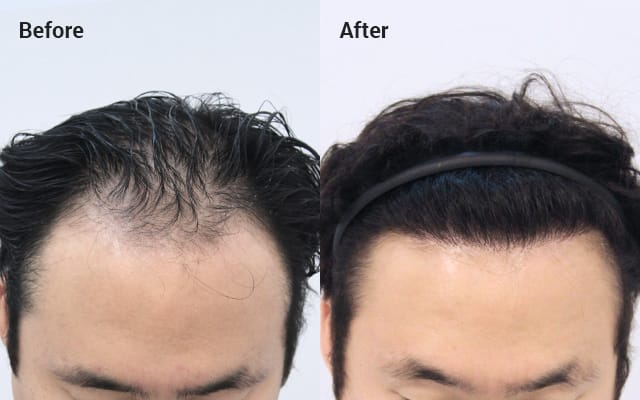 Non-incisional partial shaving. 2000 hair follicles. 10 months later image