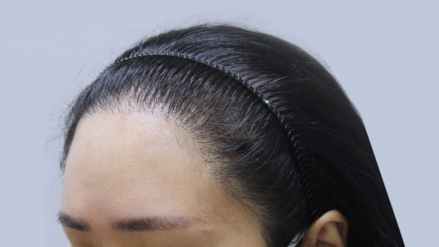 hairline image