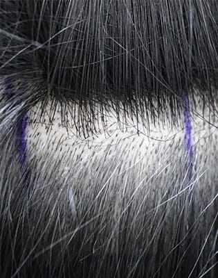 Only hair follicles to be collected are cut short image