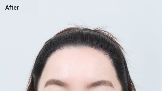 M-shaped forehead after image