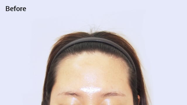 Angular shaped forehead before image
