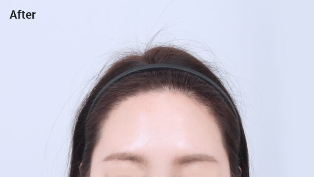 Angular shaped forehead after image