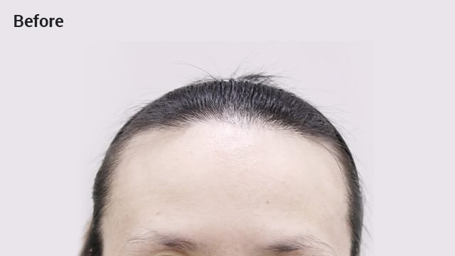 High forehead before image