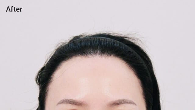 High forehead after image